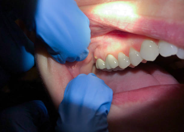 Best Emergency Gum Treatment in Cumberland Center, ME
